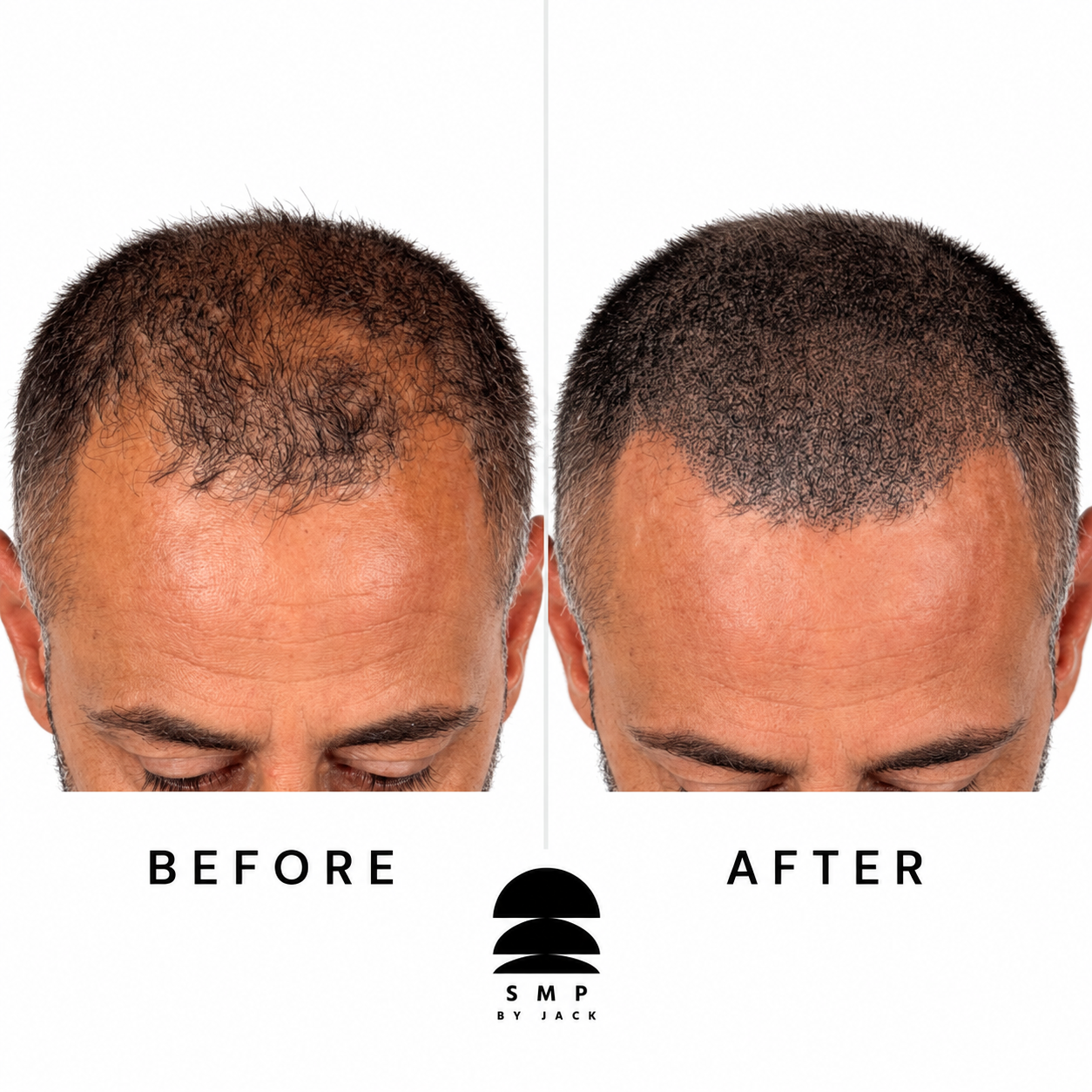Before and after scalp micropigmentation hairline rebuild by SMP by Jack, Newport South Wales