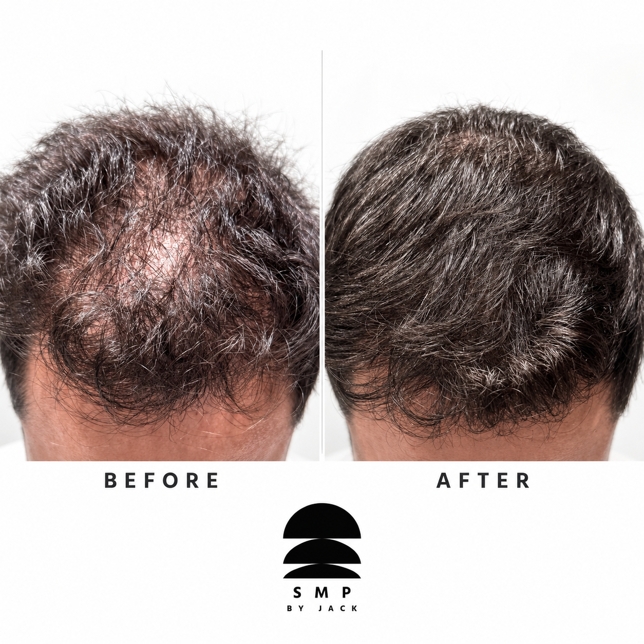 Before and after SMP density restoration for thinning hair, SMP by Jack South Wales